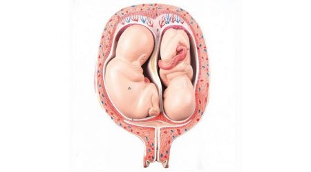 5th Month Twin Foetuses - Normal Position
