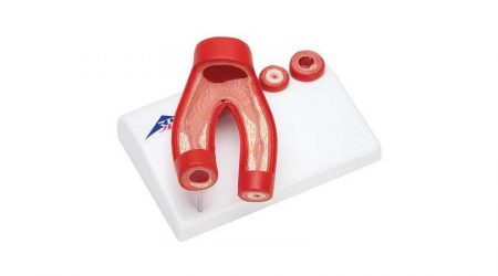 Arteriosclerosis Model