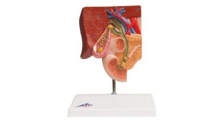 Gallstone Model