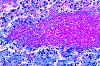 Prepared Microscope Slide. Chronic tuberculous pulmonary cavity with bacteria *