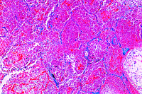 Prepared Microscope Slide. Necrotic (cheesy) pneumonia