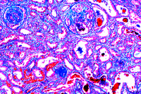 Prepared Microscope Slide. Chronic glomerulonephritis