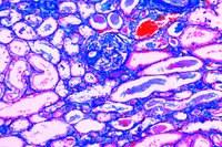 Prepared Microscope Slide. Amyloid degeneration of kidney