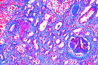 Prepared Microscope Slide. Glomerularatrophy of kidney (cirrhosis)