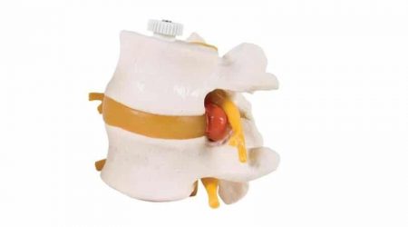 2 Lumbar Vertebrae with prolapsed disc, flexibly mounted