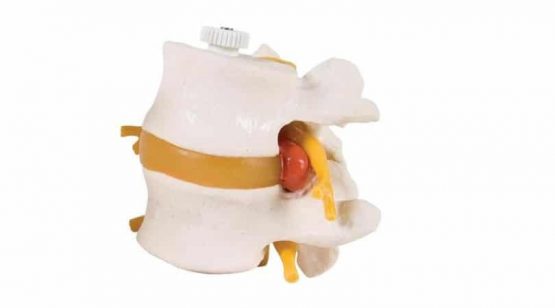 2 Lumbar Vertebrae with prolapsed disc, flexibly mounted