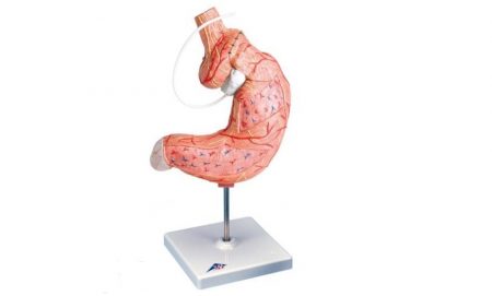 Gastric Band Model