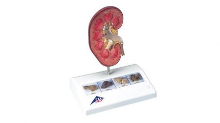 Kidney Stone Model